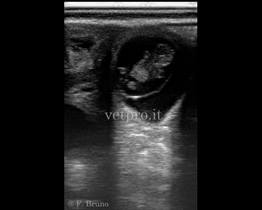 Diagnosi di gravidanza (45 gg)