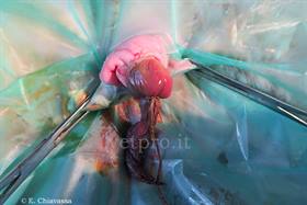 Removal of persintent umbilical arteries